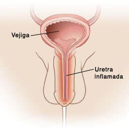 Imagen de las vías urinarias masculinas, en la que se ve la ubicación de la vejiga, el uréter, la próstata, la uretra y los testículos.