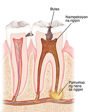 Cross section ng dalawang ngipin na ipinapakita ang butas, impeksiyon, at pamumuo ng nana sa ngipin.