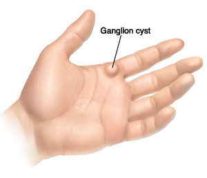 Hand with ganglion cyst on joint of pointer finger.