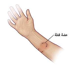 ذراع إنسان يظهر عليها جروح ثاقبة وجلد محمر ناتج عن عضة قطة. المسميات تشتمل على: عضة قطة