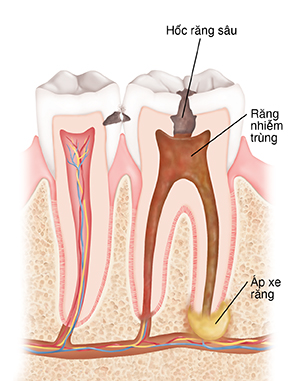 Mặt cắt ngang của hai chiếc răng cho thấy hốc răng sâu, nhiễm trùng và áp xe răng.