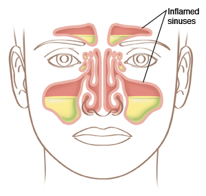 Illustration of the face showing inflamed sinuses.