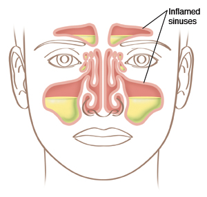 Location of sinuses on face, with inflamed sinuses.