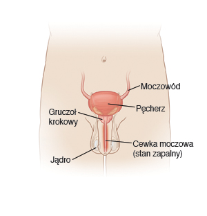 moczowód, pęcherz, gruczoł krokowy, cewka moczowa (stan zapalny), jądro