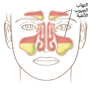 شكل توضيحي للوجه يبين التهابًا في الجيوب الأنفية.