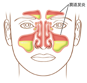 图示面部窦道发炎