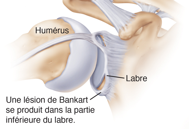 Vue de devant de l'articulation de l'épaule montrant une lésion SLAP et une lésion de Bankart.