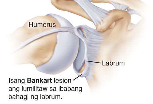 View sa unahan ng kasukasuan ng balikat na makikita ang SLAP tear at Bankart tear.