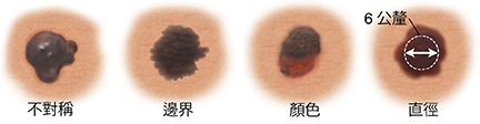 形狀不對稱的痣。邊緣模糊不均勻的痣。有深色和淺色斑點的痣。直徑 6 毫米的痣。三個痣顯示痣隨時間的變化。