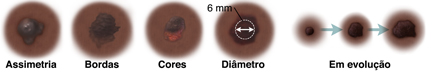 Verruga com forma assimétrica. Verruga com bordas irregulares e desfocadas. Verruga com pontos escuros e claros. Verruga com 6 mm de diâmetro. Três verrugas mostrando as alterações ao longo do tempo.