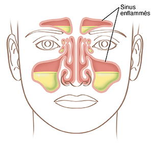 Illustration d'un visage montrant des sinus enflammés.